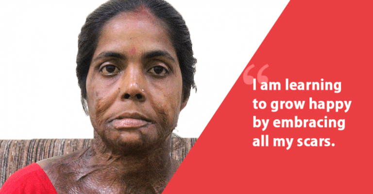 Moyna Pramanik: Does An Acid Attack And A Scarred Face Make Me Unladylike In The Society?