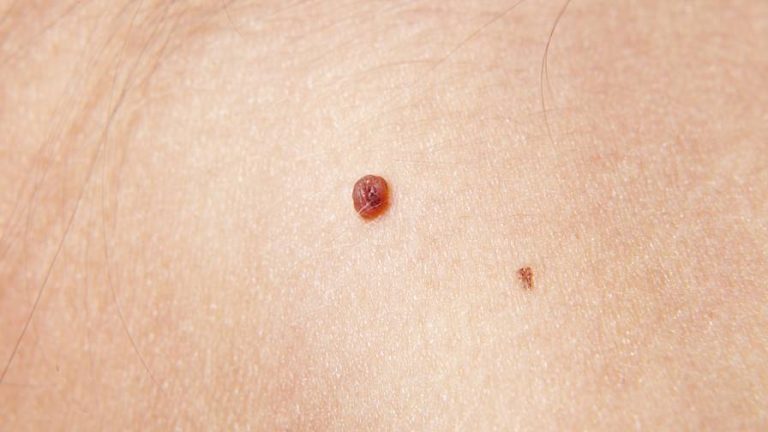 Skin Tags: Causes, Symptoms And Removal