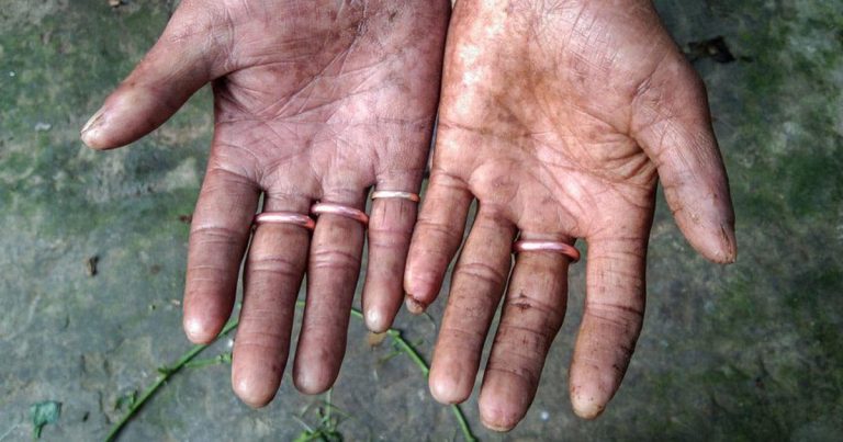 The Men In This Family From Bangladesh Have No Fingerprints Since Four Generations
